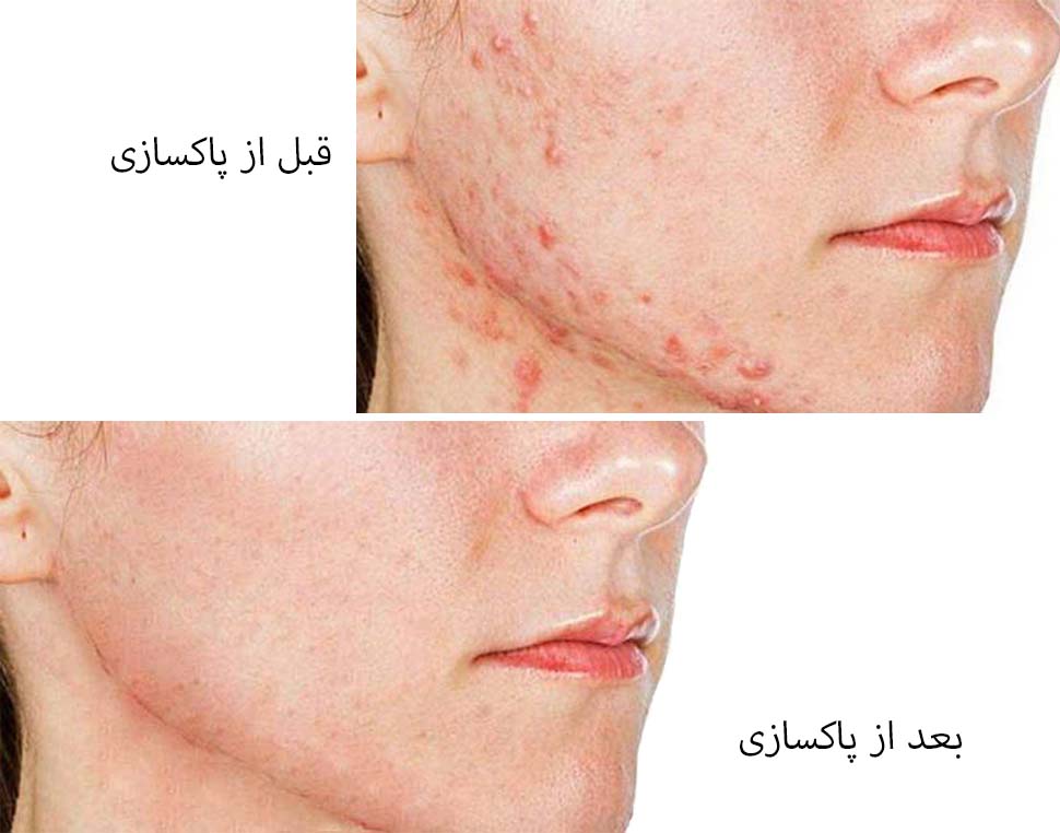 پاکسازی طبیعی صورت 2