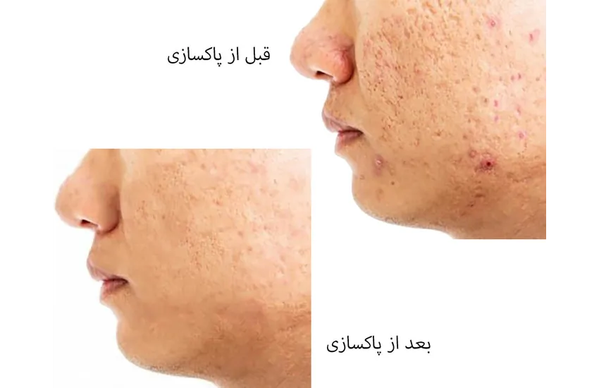 0-پاکسازی طبیعی صورت 1