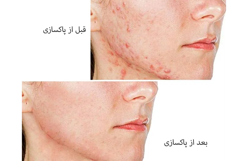 0-پاکسازی طبیعی صورت 2